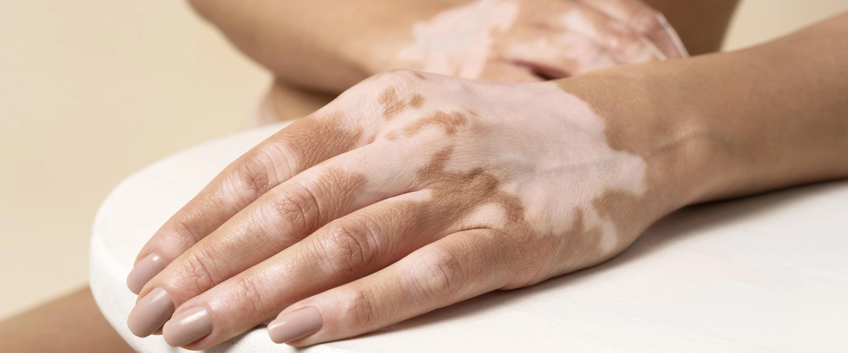 Młoda kobieta z bielactwem